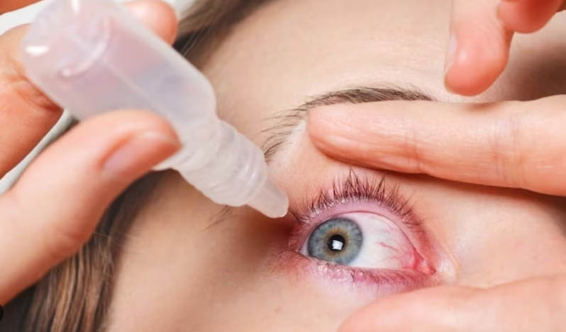 conjuctivitis